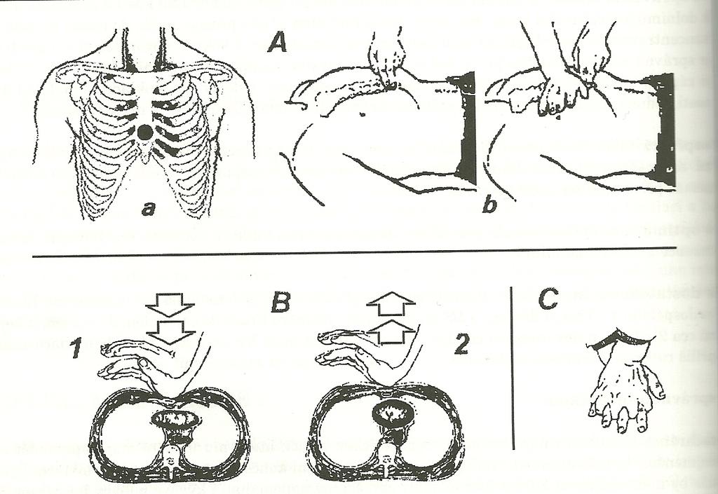 Příloha E - nepřímá srdeční masáž Nepřímá srdeční masáž dospělého člověka A - lokalizace správného masážního bodu: a) schématické zobrazení b)