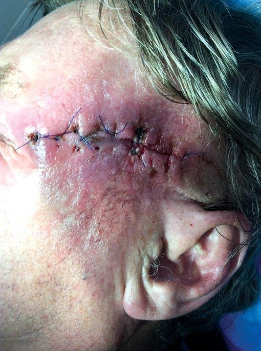 Infekce s nekrózou Obr. 4 Dehiscence Obr. 5 některý typ tohoto léku oproti 0,7 % u kontrolních pacientů.