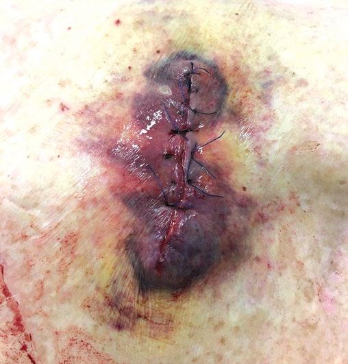 ÚVOD Dermatochirurgie v posledních letech nabyla na významu a v praxi se značně vyvinuly chirurgické možnosti včetně rozsahu výkonů.