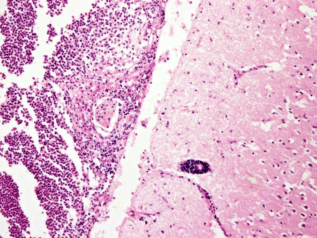 Purulentní leptomeningitida