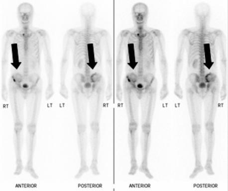 infiltrace pleury, masivní fluidothorax