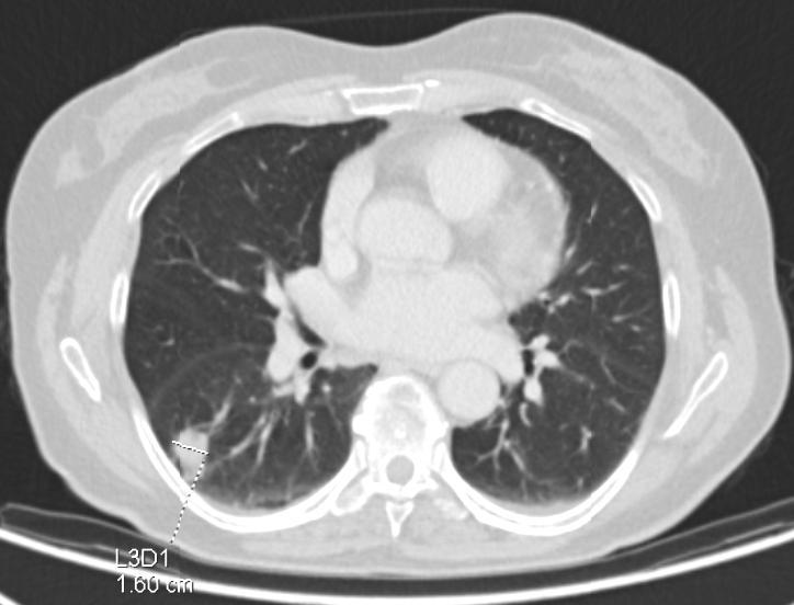 (HRCT) PET/CT Scintigrafie skeletu