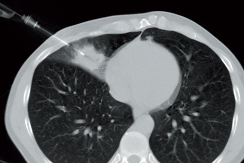 Odběr tkáně k histologickému vyšetření Bronchoskopie