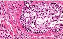 Laboratorní vyšetření Nádorové tkáně Morfologie - cytologie,