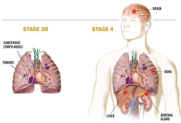 +/-chemoterapie pokud není indikována operace (studie na kombinaci s imunoterapií) Stadium IIIB IV