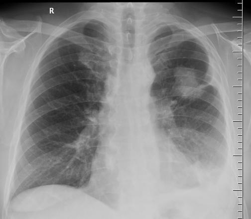 Cílená léčba a imunoterapie - výrazné zlepšení léčby NSCLC 1 2 1.