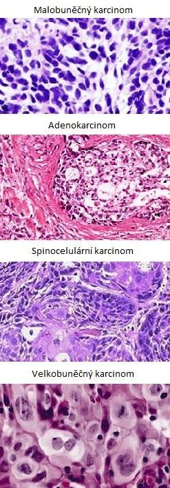 Rozdělení dle morfologie Malobuněčný karcinom (SCLC) - 15% Nemalobuněčný karcinom (NSCLC) - 85% Adenokarcinom - 45% Skvamozní (dlaždicobuněčný) karcinom - 35% Velkobuněčný
