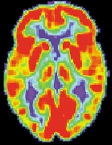 Diferenciální diagnostika Neurodegenerativní onemocnění Alzheimrova choroba Parkinsonova choroba Huntingtonova choroba Lewy body disease Frontotemporální demence Kortikobazální degenerace