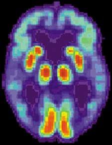 Cerebrální autosomální dominantní arteriopatie, subkortikální infarkty a leukoencephalopatie Vertebrobazilární insuficience Infekční onemocnění Borrelióza HIV syfylis Urologická onemocnění