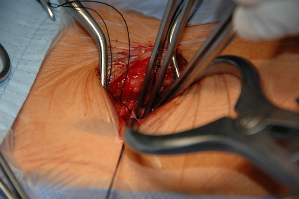 Implantace