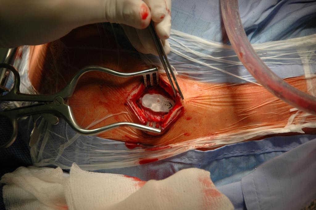 Implantace