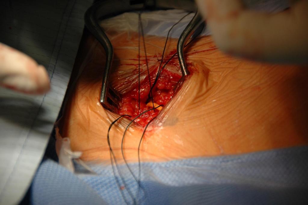 Implantace