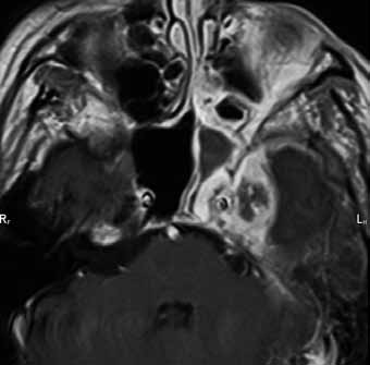 3D TOF MR angiography shows presence of two small pseudoaneurysms of the left lacerous ICA segment due to inflammatory involvement of the petrous apex (right). Literatura 1. Atlas SW, et al.