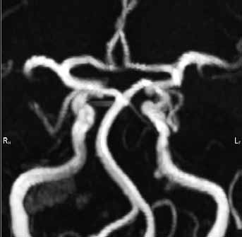 4 360. 3. Edelman RR, Hesselink JR, Zlatkin MB, et al. Clinical Magnetic Resonance Imaging. Philadelphia: Saunders 2006; 1181 1214. 4. Grossman RI, Yousem DM. Neuroradiology. The Requisites.