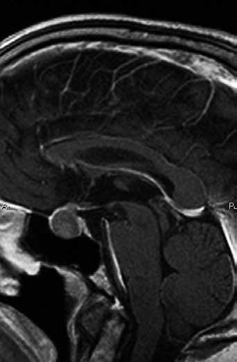 Intraselární cysta Rathkeho výchlipky s mírnou supraselární propagací a vysokým obsahem bílkoviny: nativně T1 hyperintenzní (vlevo), T2 výrazně hypointenzní