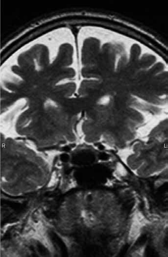 Intrasellar Ratke cleft cyst with mild suprasellar extension and protein rich content: T1 hyperintense (left), markedly T2 hypointense (middle), with no