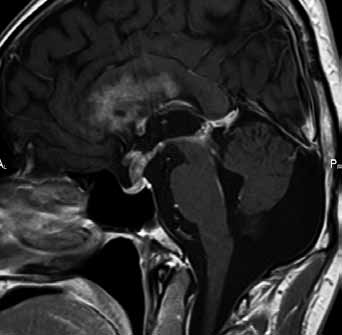 Suprasellar germinoma (left) with numerous subependymal metastases (right) on T1 weighted contrast enhanced images reckého sedla a erozi jeho opěradla.