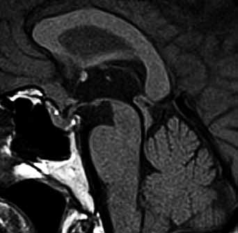 Menigeoma of tubercullum sellae extending into sella turcica on unenhanced (left) and contrast enhanced T1 weighted images (right) LIPOM Intrakraniální lipom není v pravém smyslu slova nádorem, nýbrž