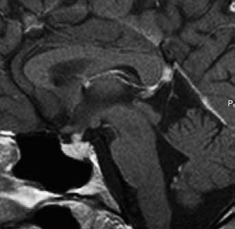 16. Lymphocytic hypophysitis in a young post partum female with thickened infundibulum on T2 weighted image (left) and contrast enhancement (right) CHORDOM Chordom vzniká z pozůstatků notochordy, a