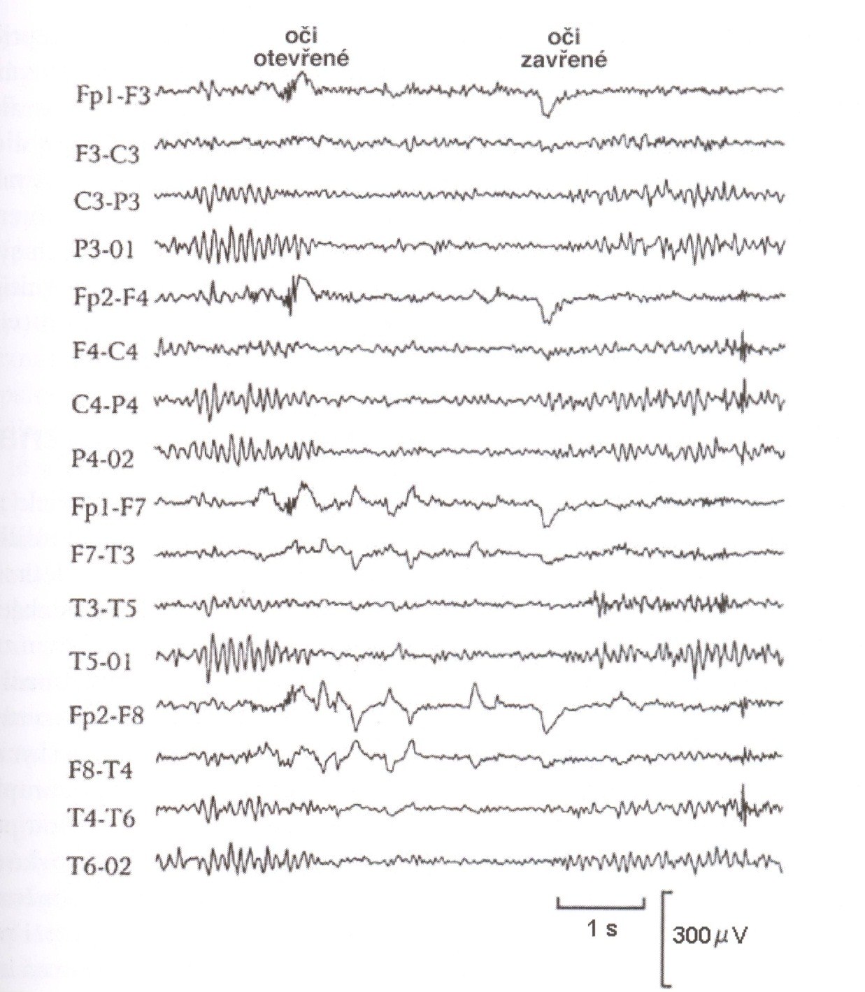 Normální EEG otevření/zavření očí (Ambler, Z.