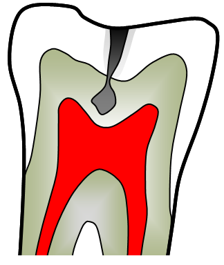d) Pokročilý zubní kaz zasažena dřeň zubu Kavity se liší podle umístění na zubu a řadí se do tříd.