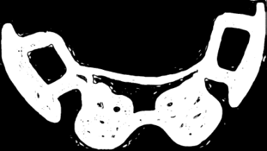 7. Popis zubních (dentálních) implantátů Dentální implantát je cizí těleso zavedené do dutiny ústní a to buď do měkkých tkání (sliznice), nebo do tvrdé kostní tkáně případně přímo do zubu pro