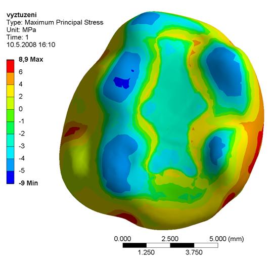 Pro názornost je deformovaný tvar v 600 násobném zvětšení (Obr. 10.7). Výplň Pryskyřice Obr. 10.7: Deformace *mm+ a první hlavní napětí skloviny s amalgámovou výplní *MPa+.