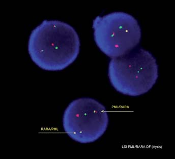 Obrázek 2. Fúzní gen PML/RARα fluorescenční in situ hybridizace (FISH) Obrázek 3. Leukemické promyelocyty APL Obrázek 4.