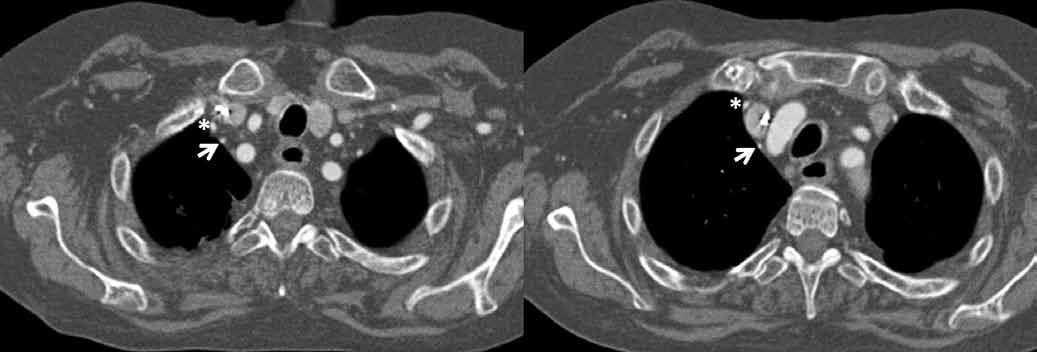 Obr. 1A Obr. 1B Obr. 1C Obr. 1. Transverzální řezy z CT angiografie (A). Multiplanární rekonstrukce (B, C). Šipka označuje anomální a. bronchialis dx., hvězdička a. thoracica interna dx. Fig. 1. Transaxial CT scans (A).