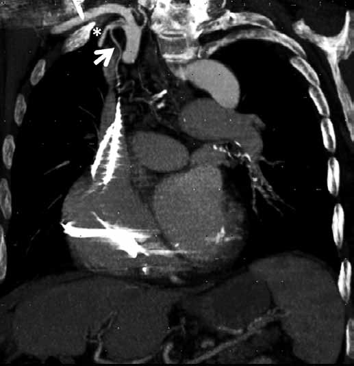 V diagnostice je důležité určit stranu krvácení. Základním vyšetřením je snímek hrudníku, bronchoskopie a CT vyšetření.