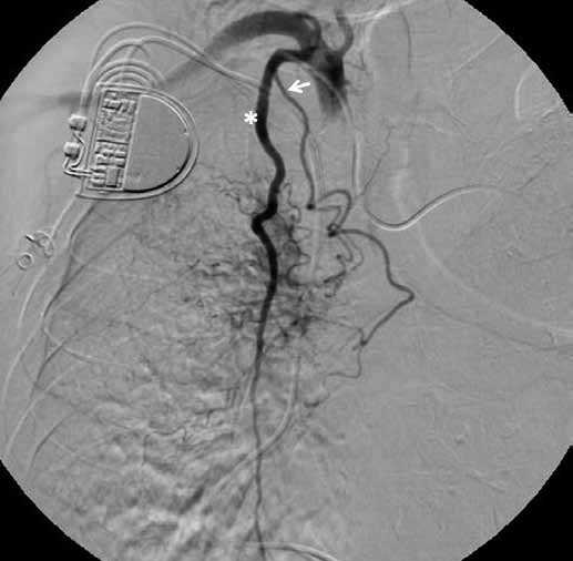 Obr. 2A Obr. 2. Angiogram pravé a. subclavia před embolizací (A), na kterém je patrná pravá bronchiální tepna atypicky odstupující z a. thoracica interna.