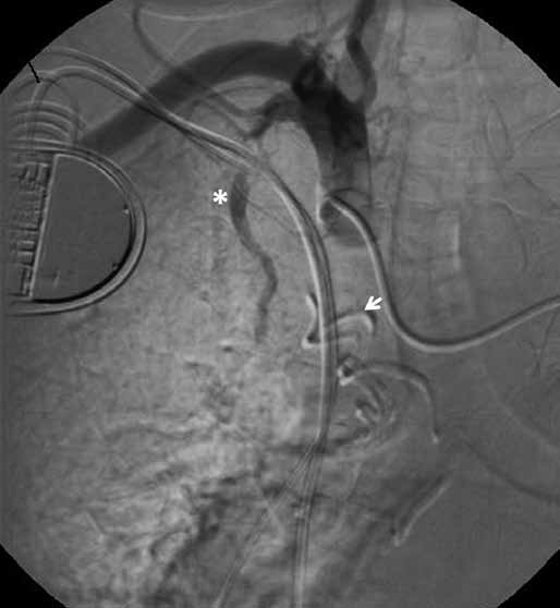 White arrow marks anomalous bronchial artery (which is embolised with N-butyl cyanoacrylate mixture on figure 2 C), Internal mammary artery is marked with asterisk. Obr. 2B Obr.