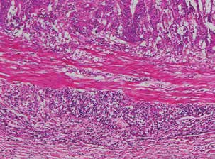 Tumor-infiltrující lymfocyty ve větším detailu (HE, původní objektiv 20x). Obr. 3.