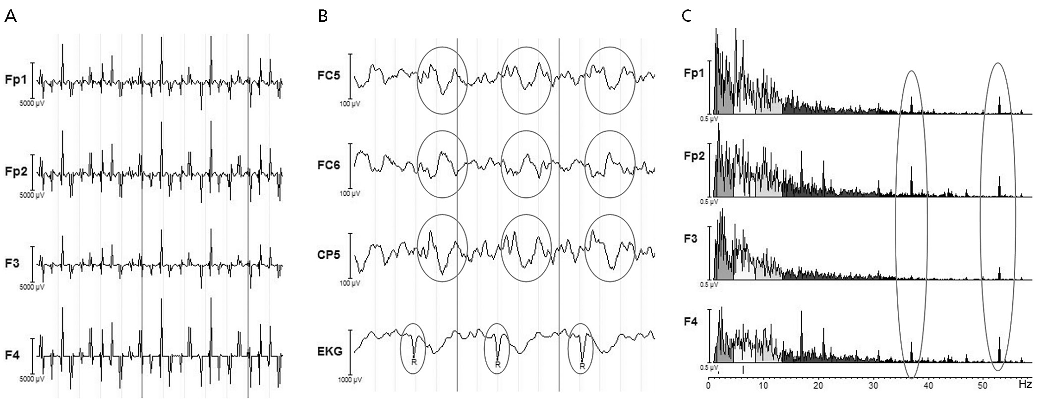 Obr. 2. Artefakty v EEG signálu. a) gradientní artefakt, b) pulzní artefakt, c) artefakt způsobený pumpou chladicí kapaliny ve formě špiček ve spektru EEG signálu, typicky kolem 40 Hz. tody AAS, např.