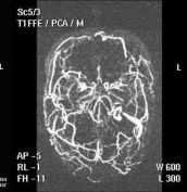 Vyšetření trombofilních stavů verifikovalo heterozygotní formu MTHFR: A/V 223 a homozygotní formu mutace PAI-I 4G/5G genotypu. Pacientka byla nastavena na perorální antikoagulační léčbu warfarinem.