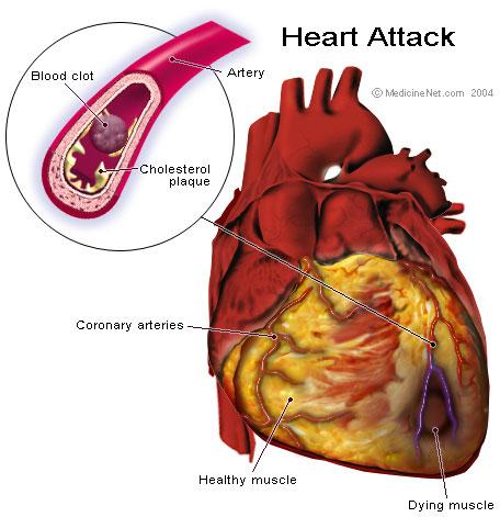 MYOKARDIÁLNÍ DYSFUNKCE globální hypokineza myokardu (myocardial stunning) nízký CO (8 hod), hypotenze (6 hod), dysrytmie, srdeční selhání terapeuticky ovlivnitelná a reverzibilní normalizace CO do 72