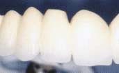 Nové systémy- kovokeramika! snaha zlepšit mechanické vlastnosti zubní keramiky!