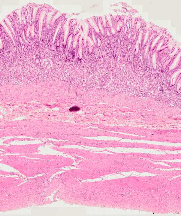 jednovrstevný cylindrický hlenotvorný ep. hluboké jamky (do 2/3 sliznice) glandulae pyloricae - mucinosní buňky - enteroendokrinní b. t.