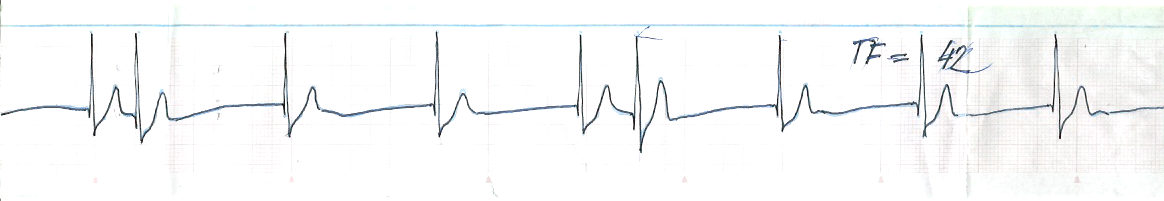 V fenomén R na T zákaz potápění Potápění nelze povolit ani tehdy, vyskytne-li se během testu zástava srdeční (sinuoatriální blok) na dobu delší než 3 sekundy.
