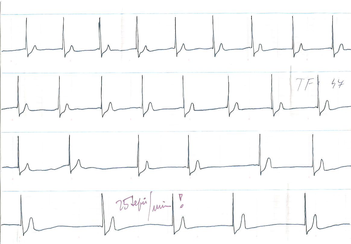 Kazuistika Obr. 2 EKG křivka č. 2: extrémní bradykardie Komentář: muž 20 let, apnoe 1 min 35 s, TF 92/min 131/min 25/min!