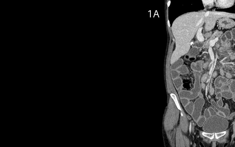 ZAJÍMAVOSTI Nová metoda pro iterativní rekonstrukci CT snímků Jednou z hlavních výzev počítačové tomografie je nabídnout vynikající kvalitu obrazů a zároveň pacienty vystavit co možná nejnižší dávce