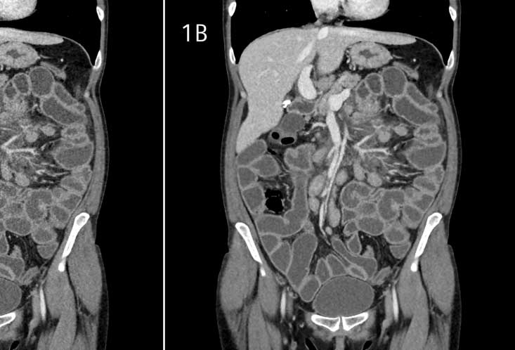 ZAJÍMAVOSTI Rekonstrukce CT dat abdominálního obrazu s využitím standardní metody FBP při plné dávce (obr. 1A) a pomocí algoritmu IRIS s radiací nižší o 60 % (obr.