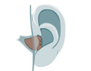 obr.2. závěsné sluchadlo 46 nitroušní tento typ sluchadla je umístěn přímo v uchu nitroušní sluchadla dělíme podle provedení na sluchadla boltcová, zvukovodová a kanálová kapesní brýlová obr.3.