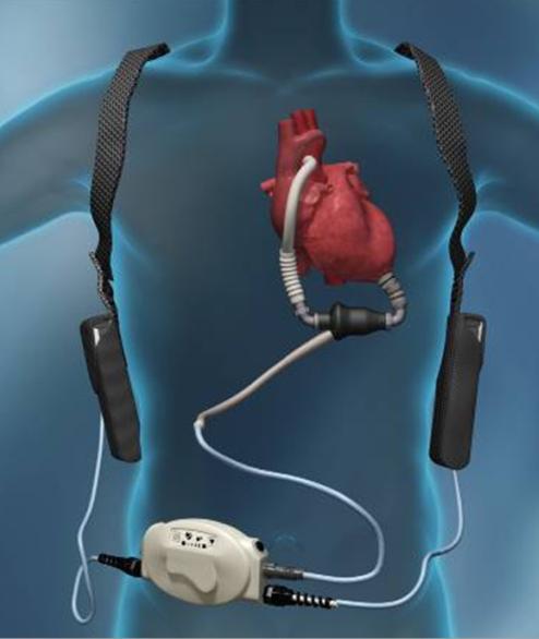 LVAD - Heart Mate II velikosti podpory Implantabilní Pumpa 8,000-10,000 RPM Až 10l / min Baterie (10 14 hod) Perkutánní kabel CMP a trombotických událostí (CMP~