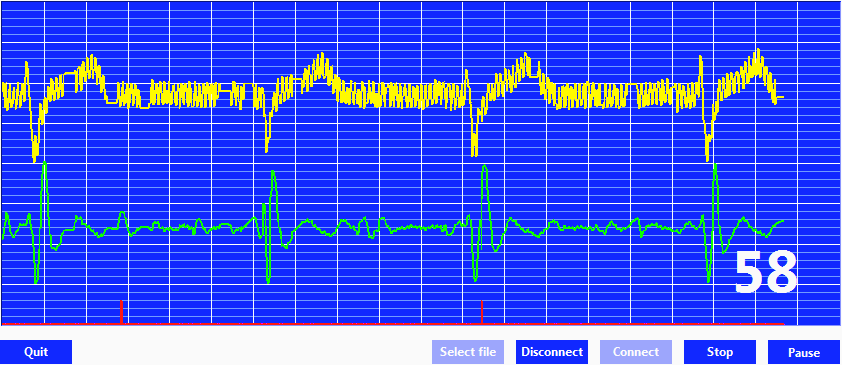 (a) 6,5 Hz aº 22,5 Hz (b) 8,5 Hz aº 15 Hz (c) 5 Hz aº 15 Hz (d) 7 Hz aº 17 Hz (e) 7 Hz aº 17 Hz, ád 3 Obrázek 15: R zné typy ltr EKG signálu (f) 7 Hz aº 18 Hz pohyb sval apod.