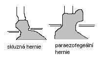 Chirurgie paracentéza ascitu u refrakterních asc. a na zač. léčby velkých asc. Během vypouštění doplňujeme plasmatický objem. Množství je cca 6 l / 90min. Možnost zavedení shuntu z bř. dut.