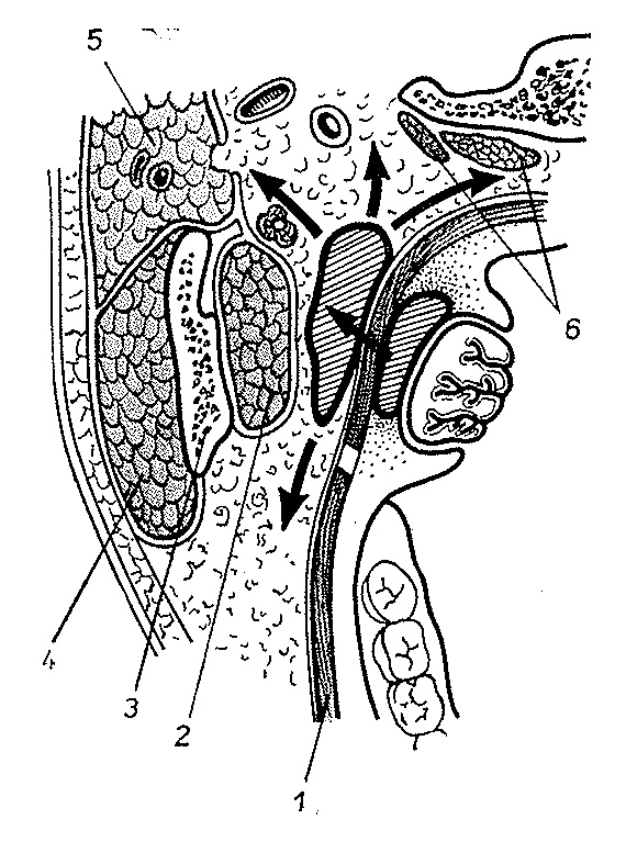 Obrázek č. 6 Spatium parapharyngicum šíření tonzilogenního parafaryngeálního abscesu 1 m. buccinator; 2 m. pterygoideus medialis; 3 ramus mandibulae; 4 m. masseter; 5 glandula parotis; 6 m.