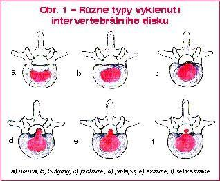 končetiny v odpovídajícím dermatomu Mechanická komprese kořene je umocněna jeho otokem, lokální ischemizací i přímou chemickou iritací (15). Obrázek 5 Stupně diskopatie Zdroj: http://img.mf.
