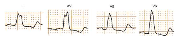 NIVC, LVH, LBBB