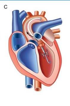 Tandem Heart Impella 2,5 / 5,0 Cheng JM, Eur Heart J,